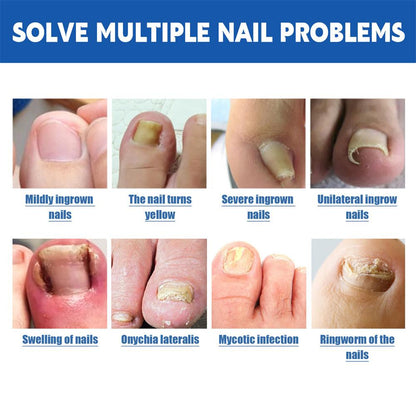 "Relieve Ingrown Toenail Discomfort with Our Specialized Patches"