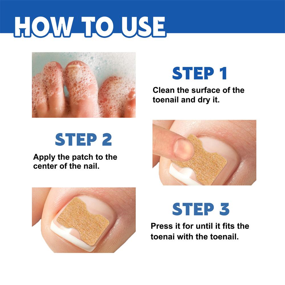 "Relieve Ingrown Toenail Discomfort with Our Specialized Patches"