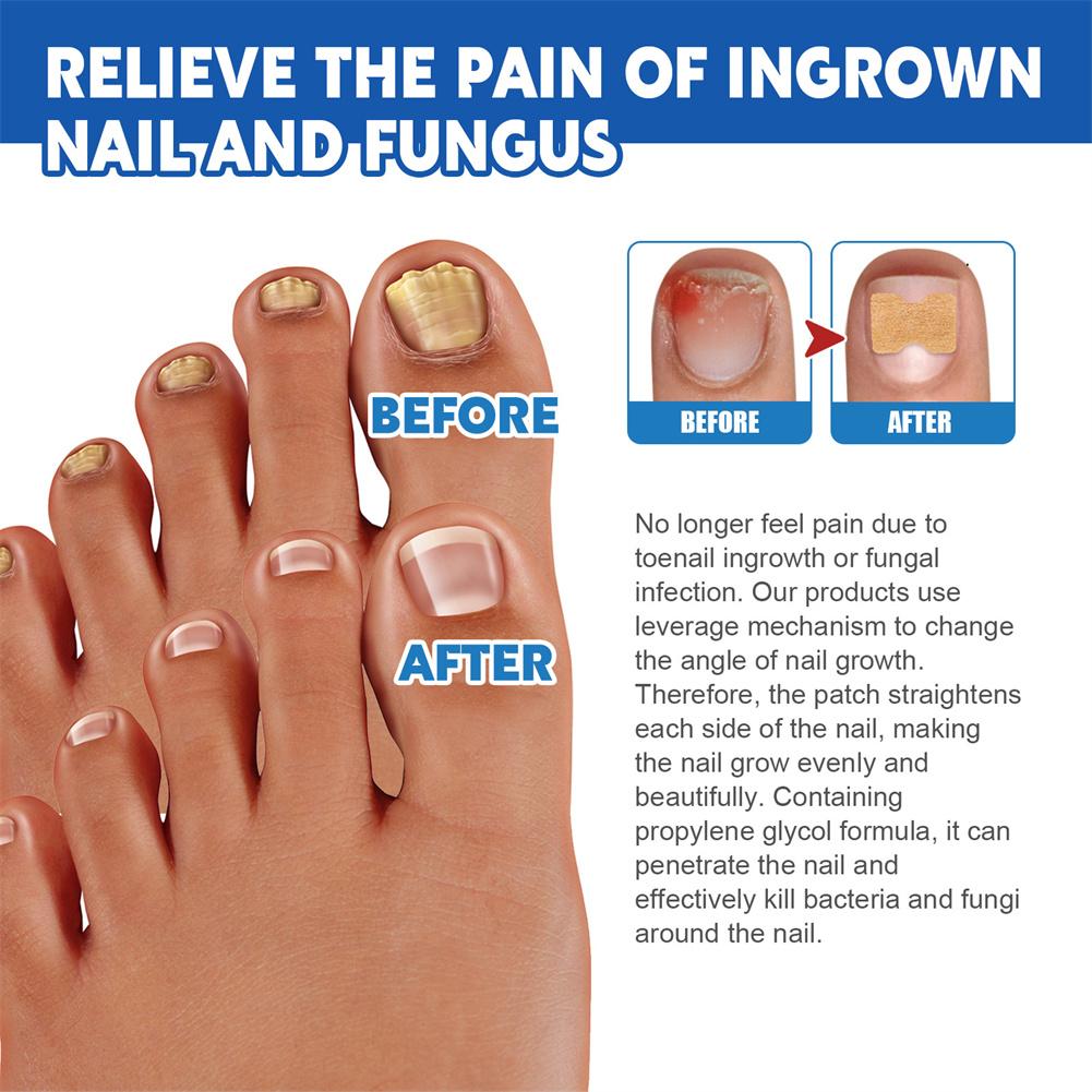 "Relieve Ingrown Toenail Discomfort with Our Specialized Patches"