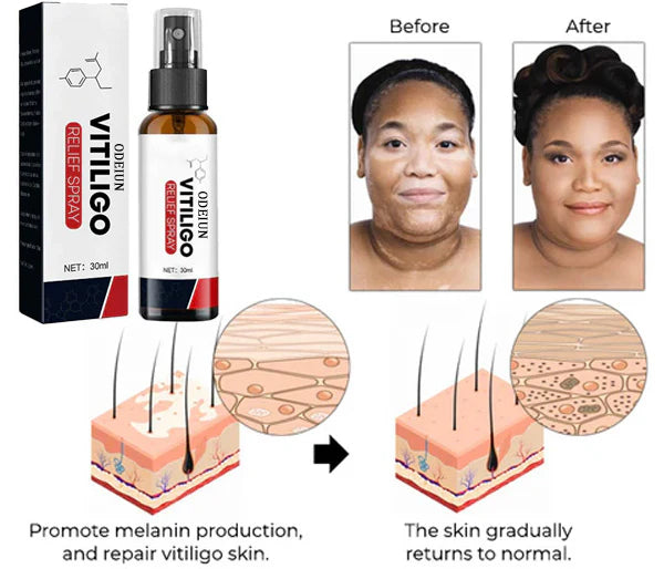 ODEIUN Vitiligo Relief Spray