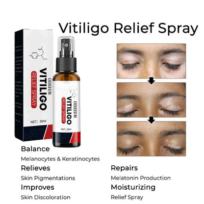 ODEIUN Vitiligo Relief Spray